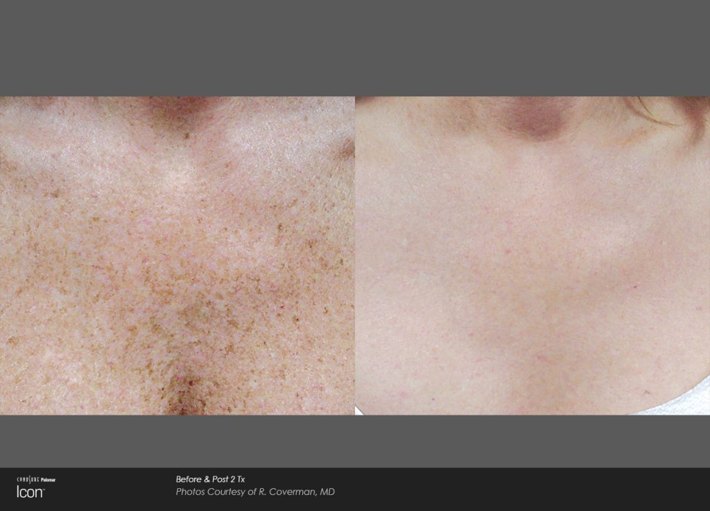 Icon Before & After Skin Resurfacing