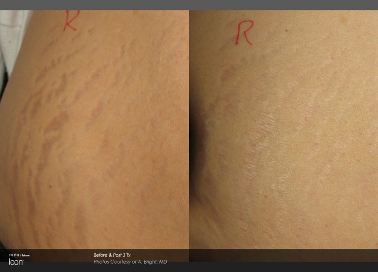 Icon Before & After Skin Resurfacing Stretch Mark Reduction