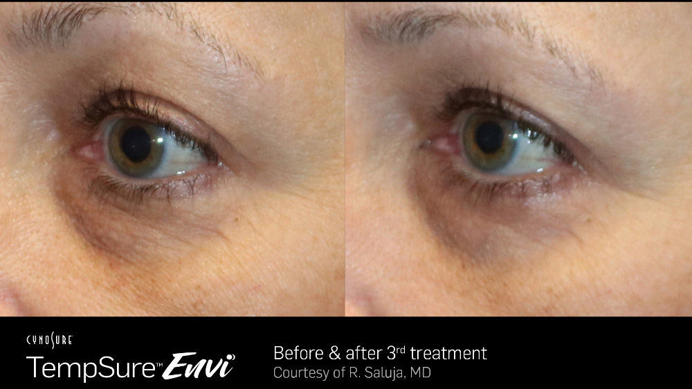 TempSure Envi BEFORE AND AFTERS