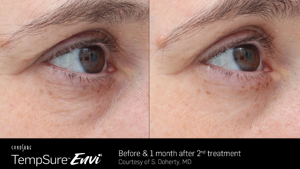 TempSure Envi BEFORE AND AFTERS