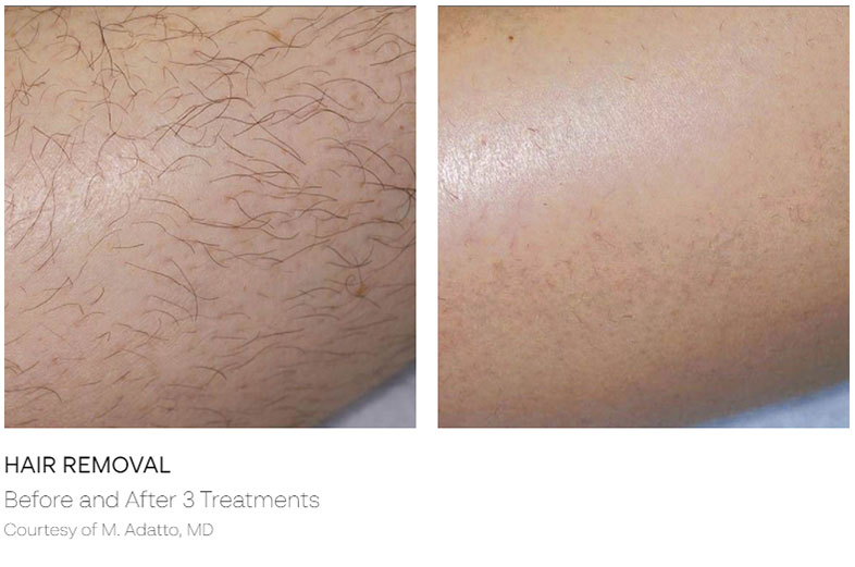 Hair Removal Before & AFter