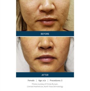 Skinpen Microneedling Before & After