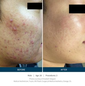 Skinpen Microneedling Before & After